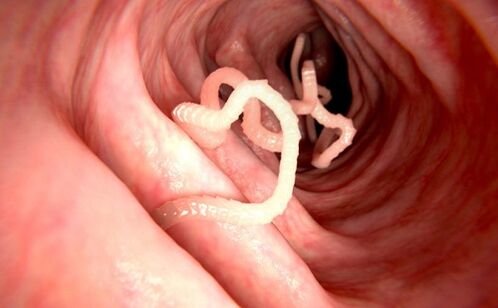 Vers dans le corps humain