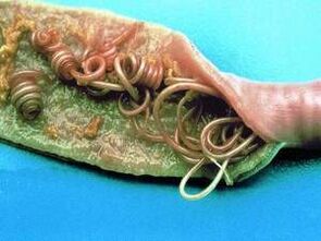 Les causes des parasites dans le corps humain