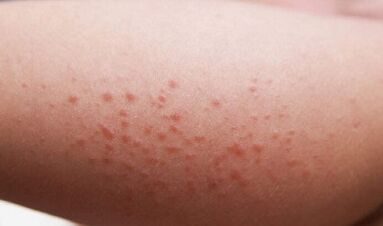 manifestations externes de la présence de parasites dans le corps